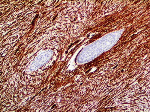 IHC of CD34 on an FFPE Dermatofibrosarcoma Tissue